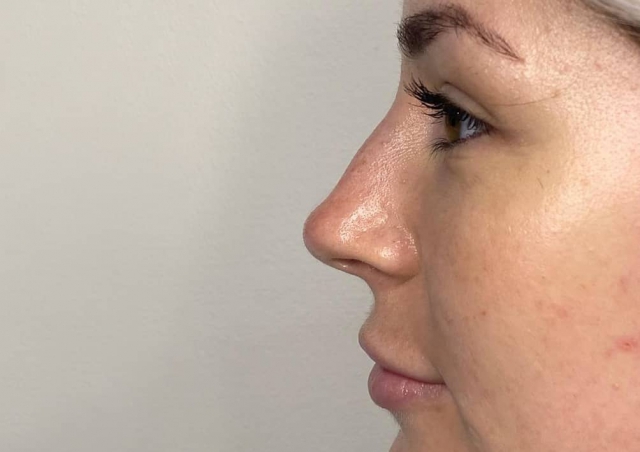 Non-Surgical Nose Augmentation