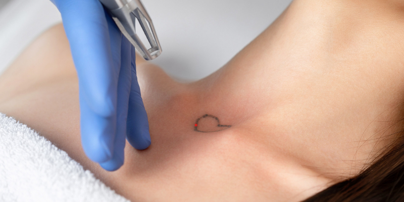 Pico Laser Tattoo Removal | Cosmetics & Wellness Clinic | Mae Cosmetics |  Norwich